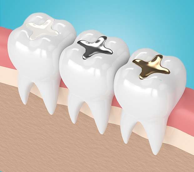 Jackson Composite Fillings