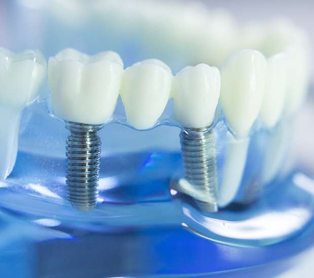 Jackson Dental Implants