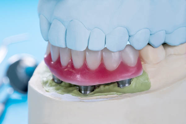 Implant Supported Dentures Jackson, MI