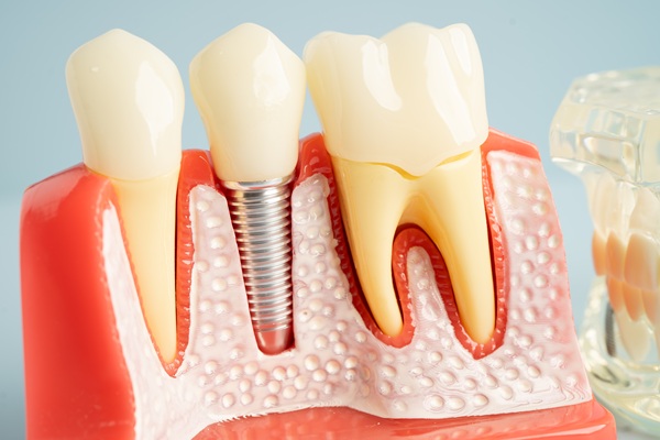 How Soon Can You Get Tooth Implants After Extraction?
