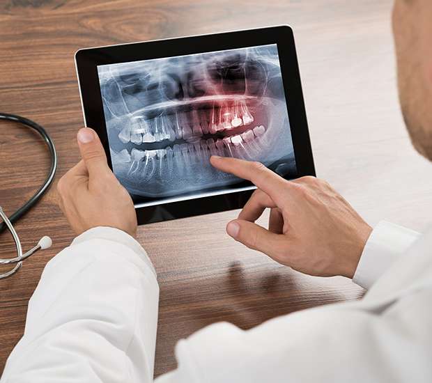 Jackson Types of Dental Root Fractures