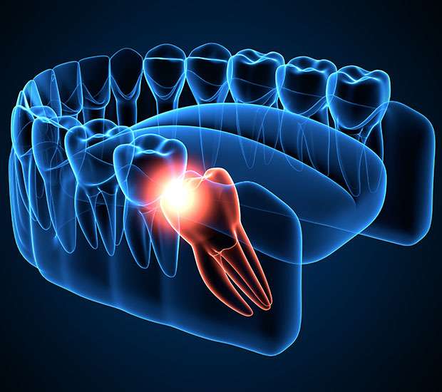 Jackson Wisdom Teeth Extraction