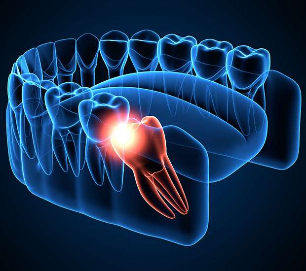 Jackson Wisdom Teeth Extraction